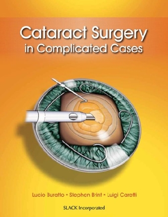 Cataract Surgery in Complicated Cases Cataract Surgery in Complicated Cases