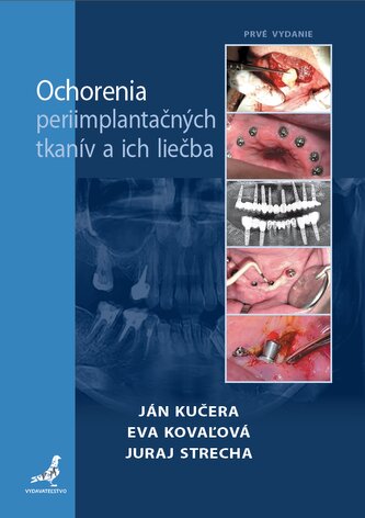 Ochorenia periimplantačných tkanív a ich liečba