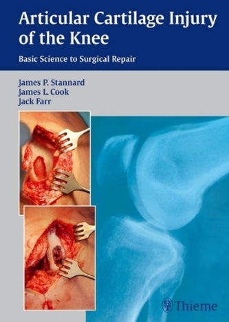 Articular Cartilage Injury of the Knee