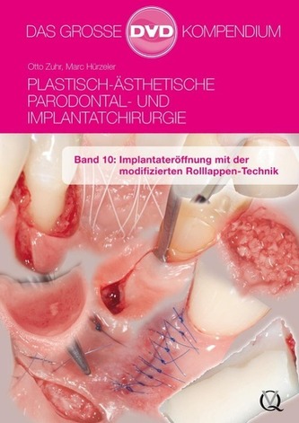 Plastisch-Ästhetische Parodontal- und Implantatchirurgie