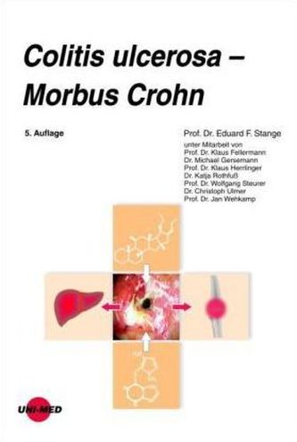 Colitis ulcerosa - Morbus Crohn Colitis ulcerosa - Morbus Crohn
