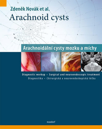 Arachnoidální cysty mozku a míchy Arachnoidální cysty mozku a míchy