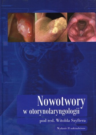 Nowotwory w otorynolaryngologii Nowotwory w otorynolaryngologii
